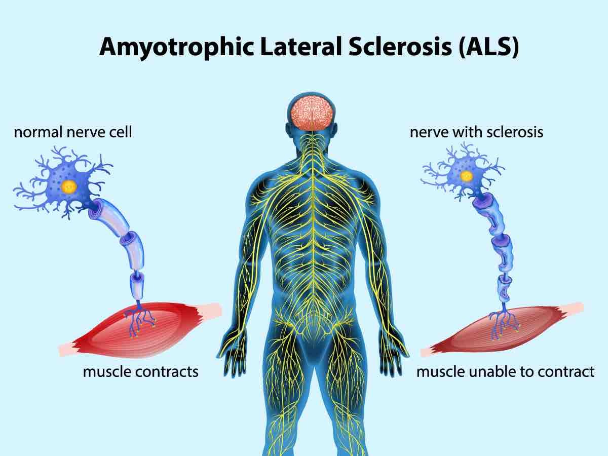 ALS motor neuron diagram