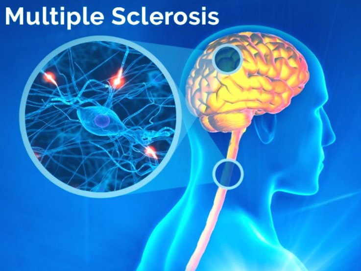 Stem cell therapy (HSCT) for Multiple Sclerosis in India