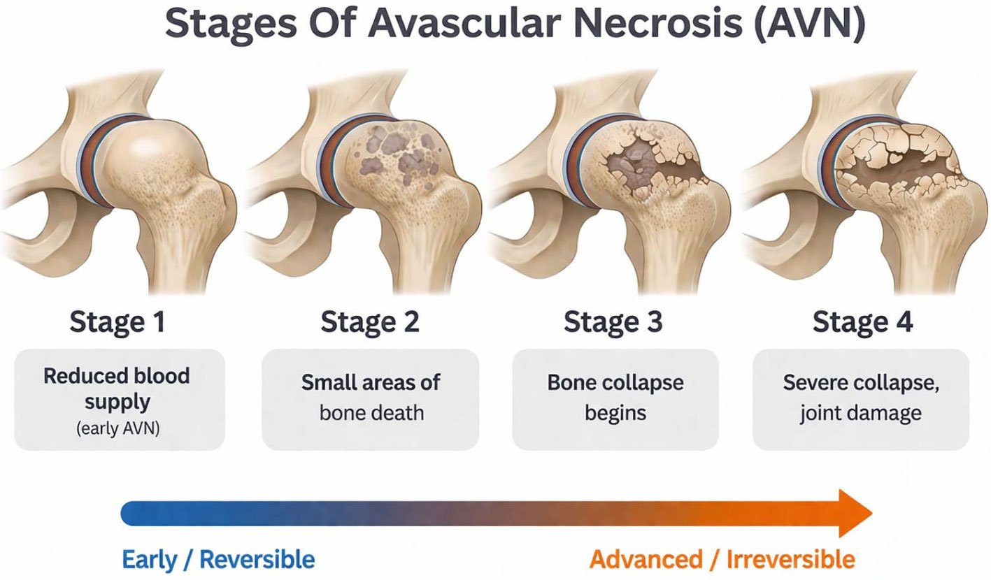 Avascular necrosis hip bone diagram