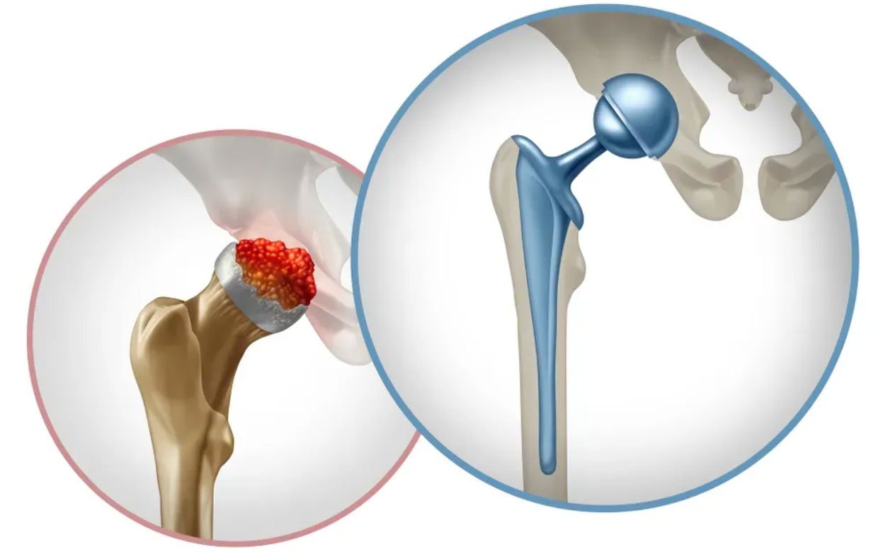 Stem Cell Therapy for Avascular Necrosis in India