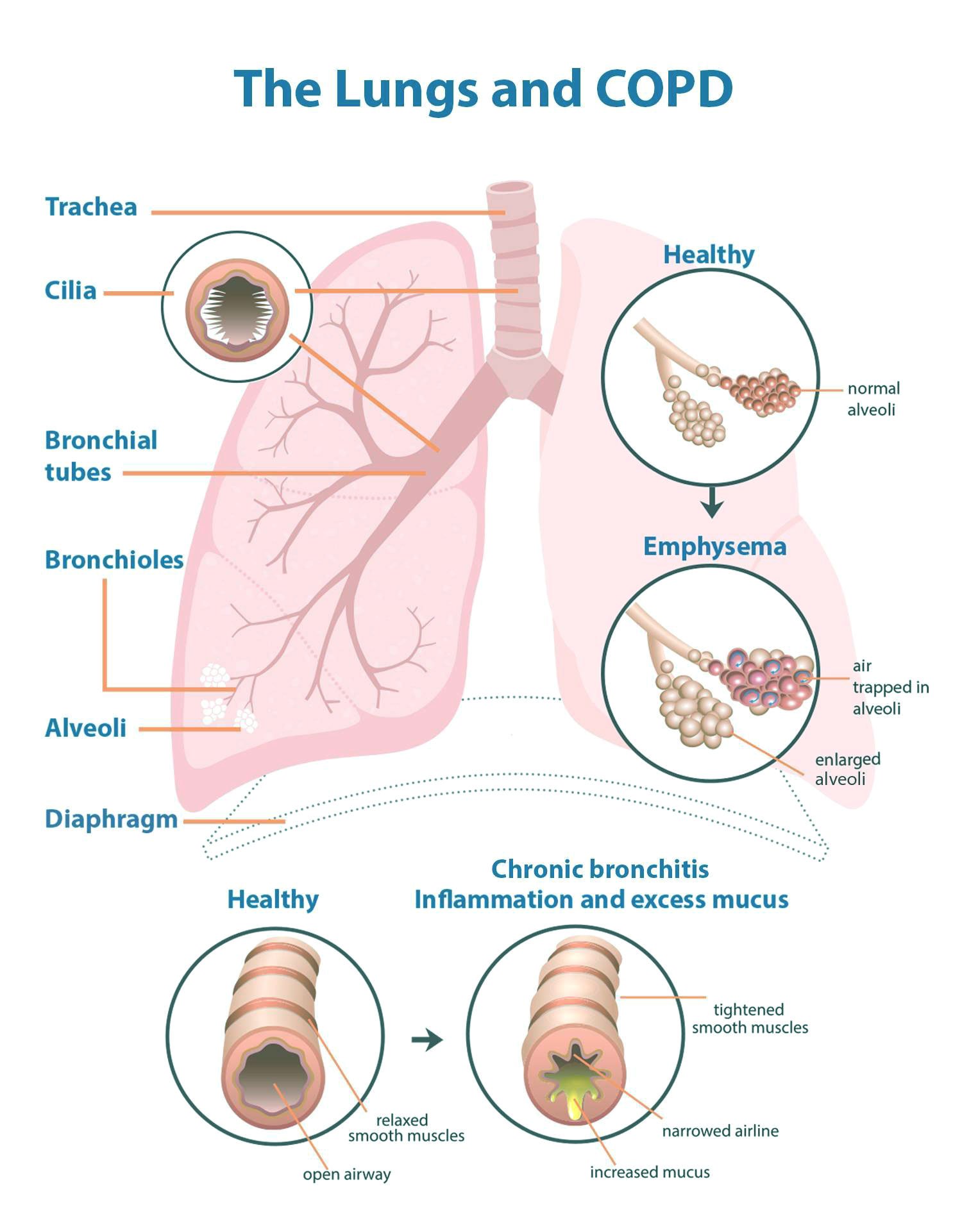 COPD lung diagram