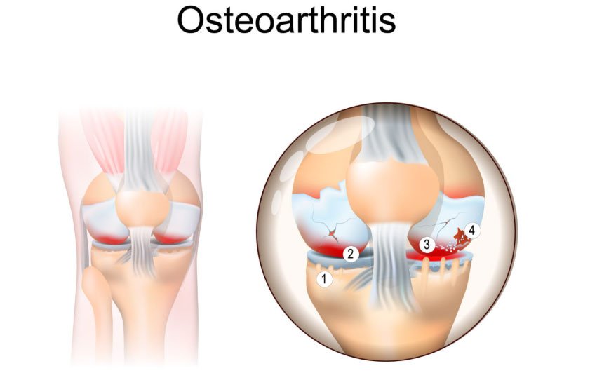 Stem Cell Therapy for Knee Osteoarthritis in India