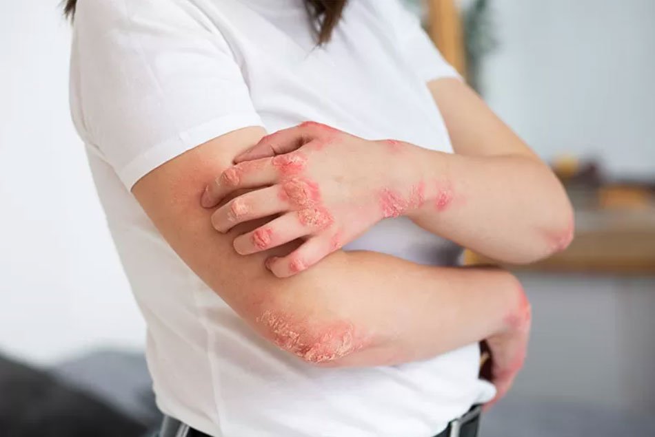 Stem cell therapy for lupus in India