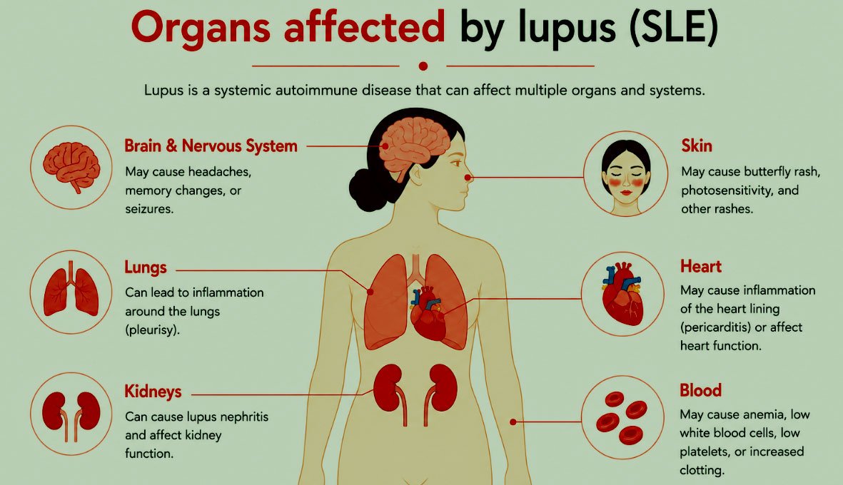 Lupus condition diagram