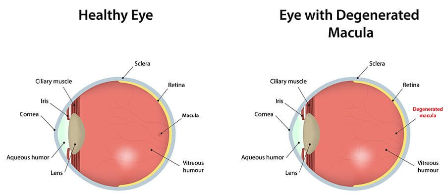 Macular degeneration retina diagram