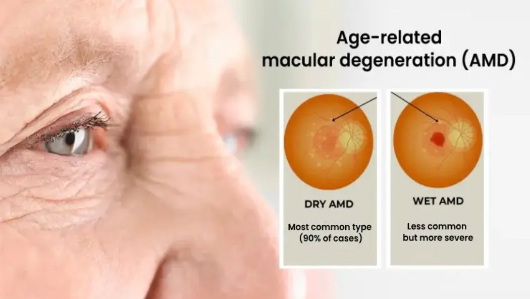 Stem cell research for macular degeneration in India