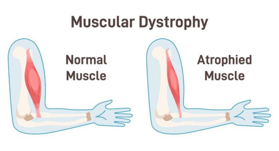 Muscular dystrophy muscle fiber diagram