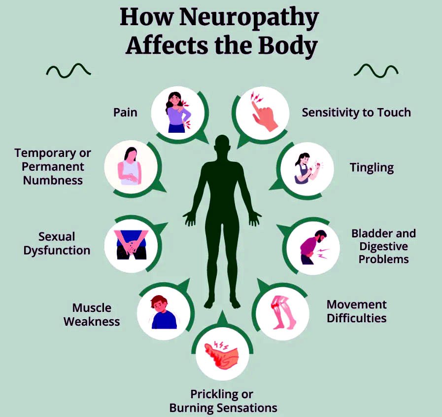 Neuropathy nerve damage diagram
