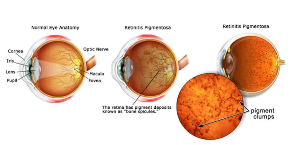 Retinitis pigmentosa retina diagram