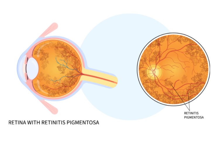Stem cell research for Retinitis Pigmentosa in India
