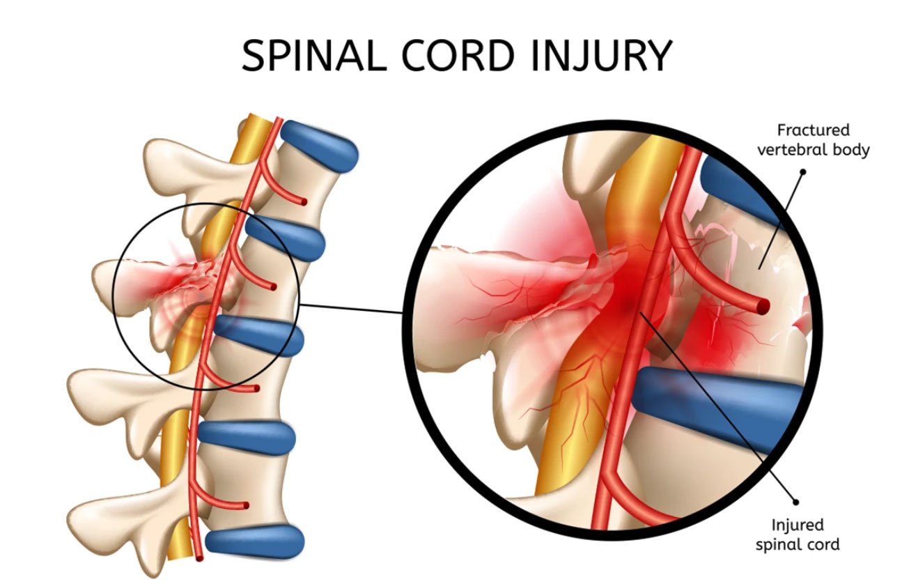 Spinal cord injury diagram