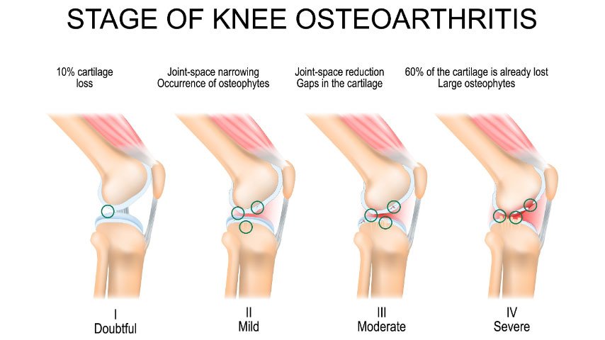 Knee osteoarthritis cartilage degeneration diagram