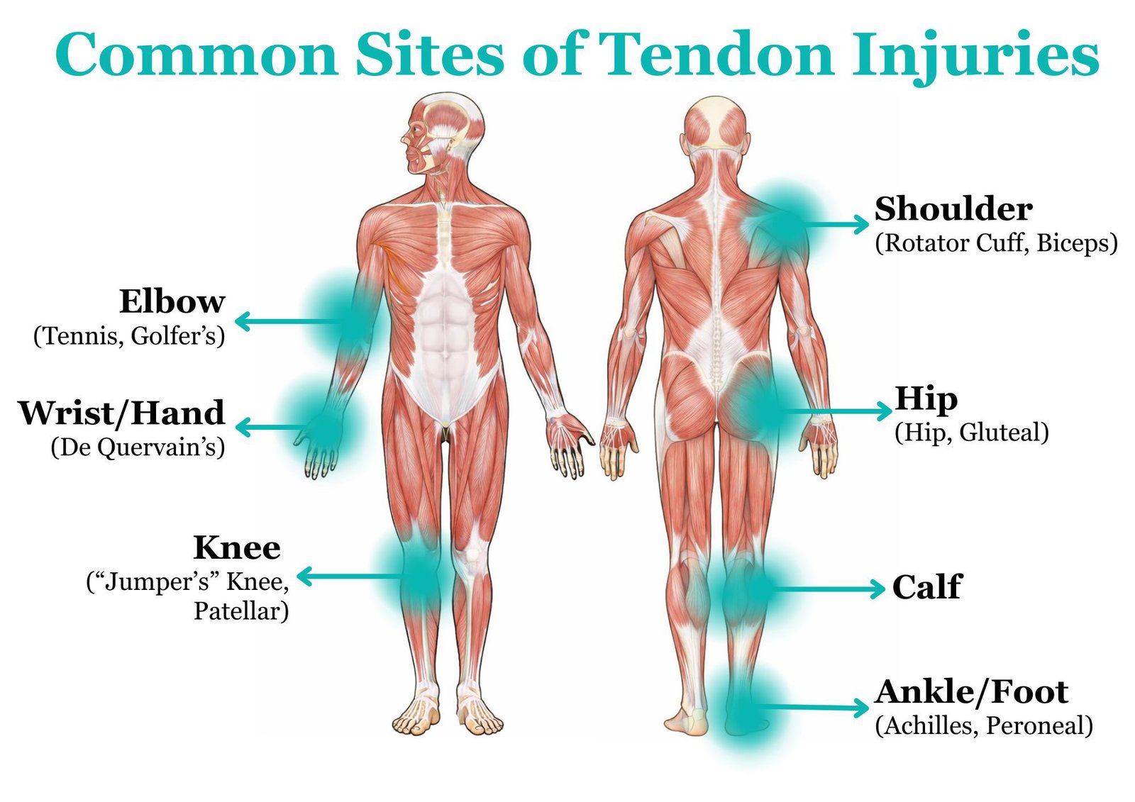 Tendon injury diagram