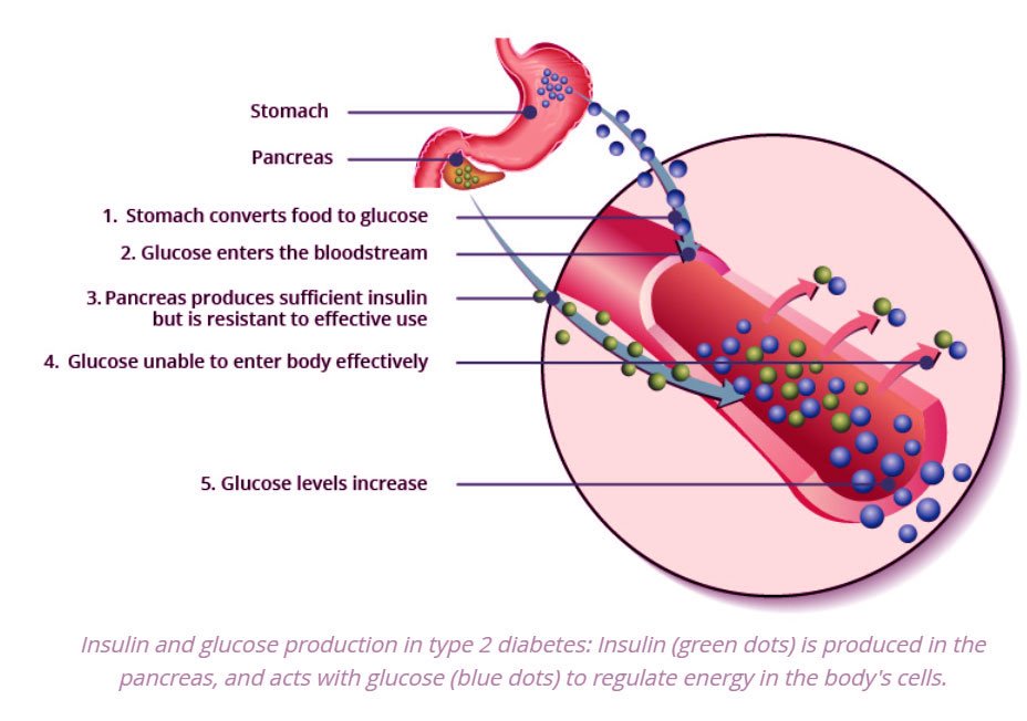 Type 2 diabetes diagram