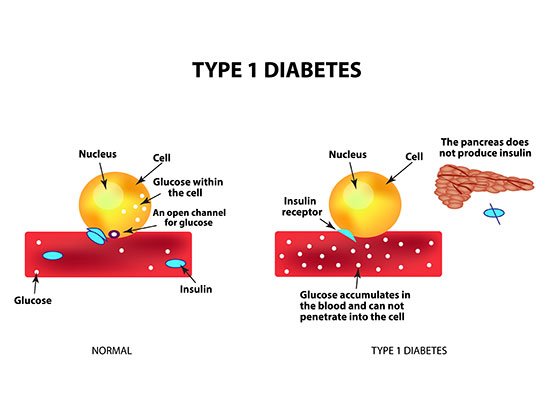 Type 1 diabetes pancreas beta cell diagram